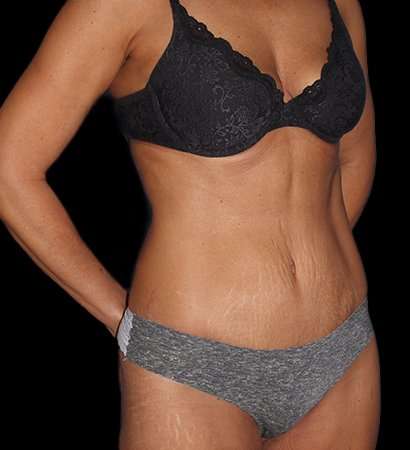 Tummy Tuck Before & After Patient #2269
