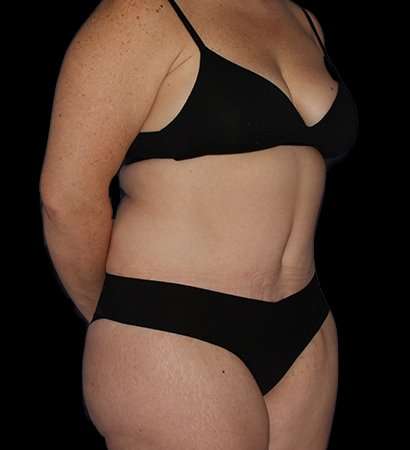 Tummy Tuck Before & After Patient #2280