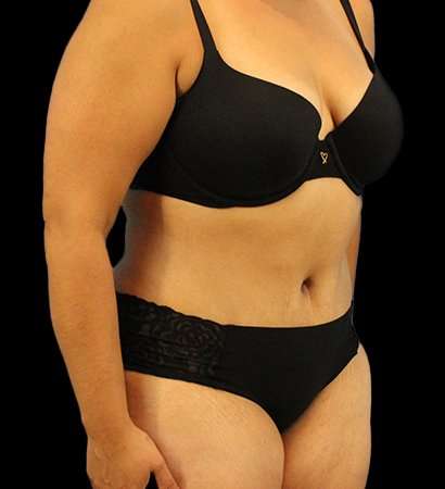 Tummy Tuck Before & After Patient #2291