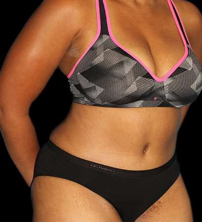 Tummy Tuck Before & After Patient #2302
