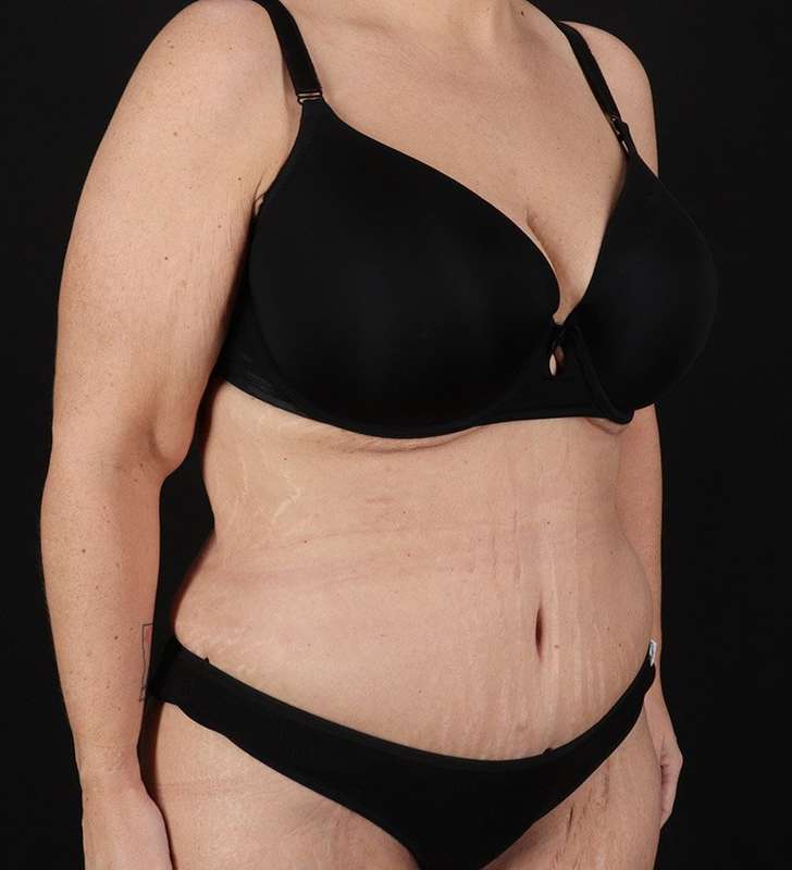 Tummy Tuck Before & After Patient #2326