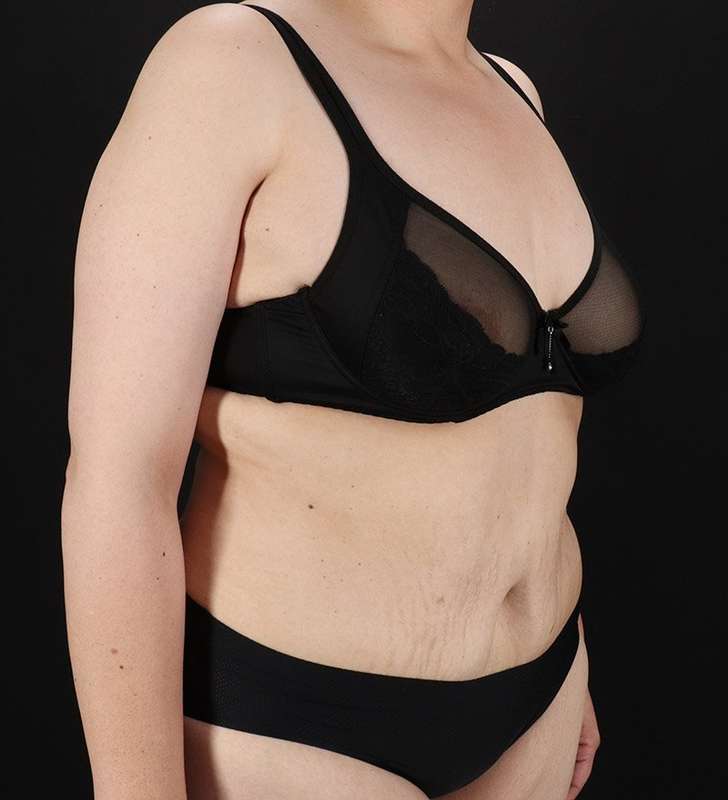 Tummy Tuck Before & After Patient #2339