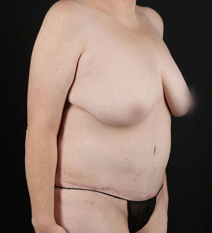 Tummy Tuck Before & After Patient #2363