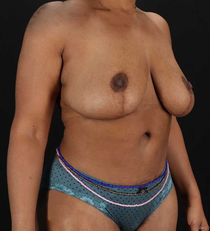 Tummy Tuck Before & After Patient #2402