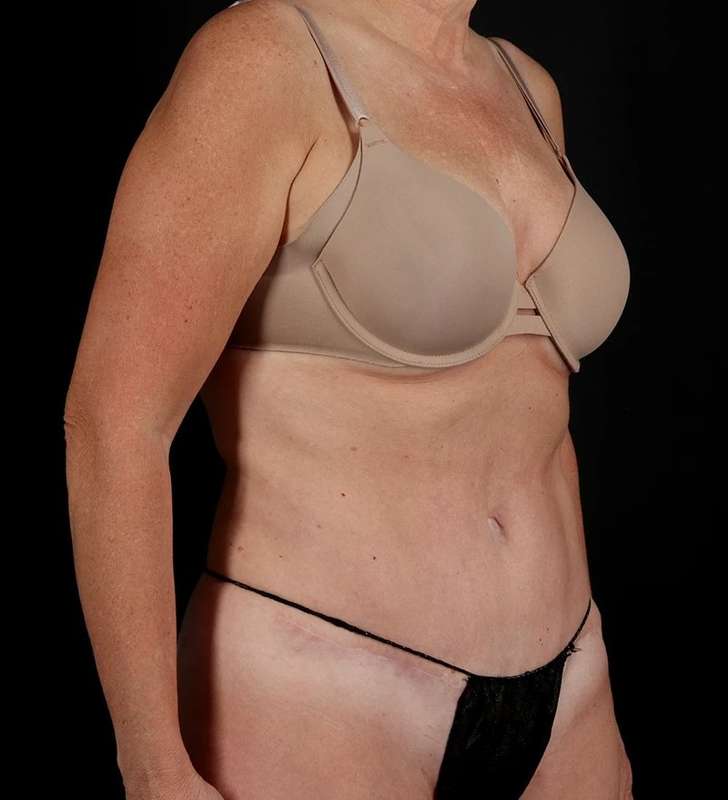 Tummy Tuck Before & After Patient #2435