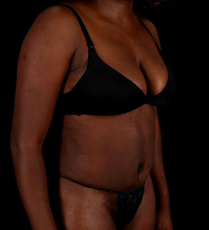 Tummy Tuck Before & After Patient #2448