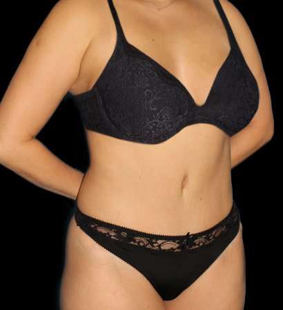 Tummy Tuck Before & After Patient #2485