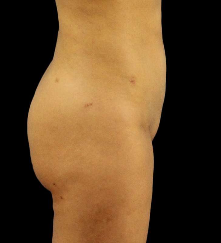 Brazilian Butt Lift Before & After Patient #2496