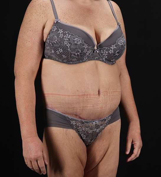 Circumferential Body Lift Before & After Patient #2509