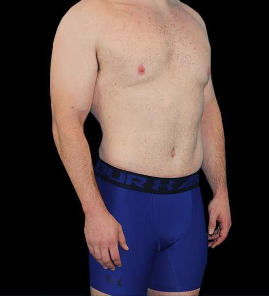Circumferential Body Lift Before & After Patient #2522