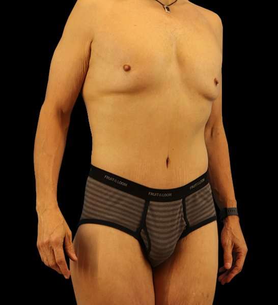 Circumferential Body Lift Before & After Patient #2535