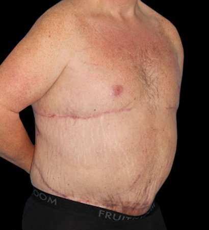 Massive Weight Loss Before & After Patient #5155