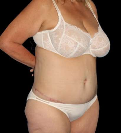Circumferential Body Lift Before & After Patient #2572