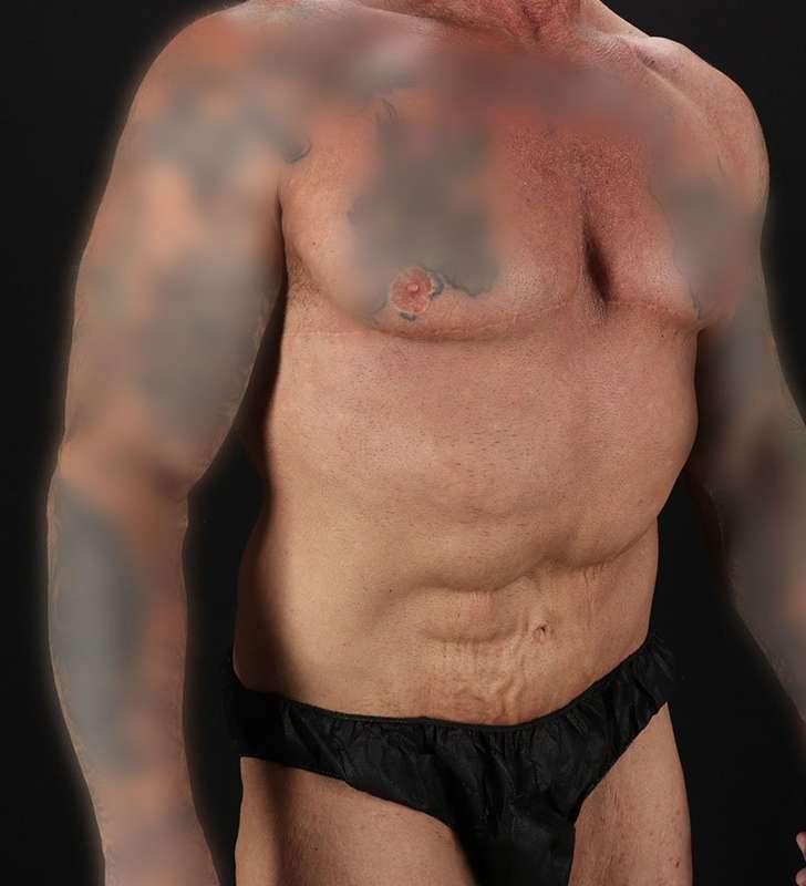 Circumferential Body Lift Before & After Patient #2611