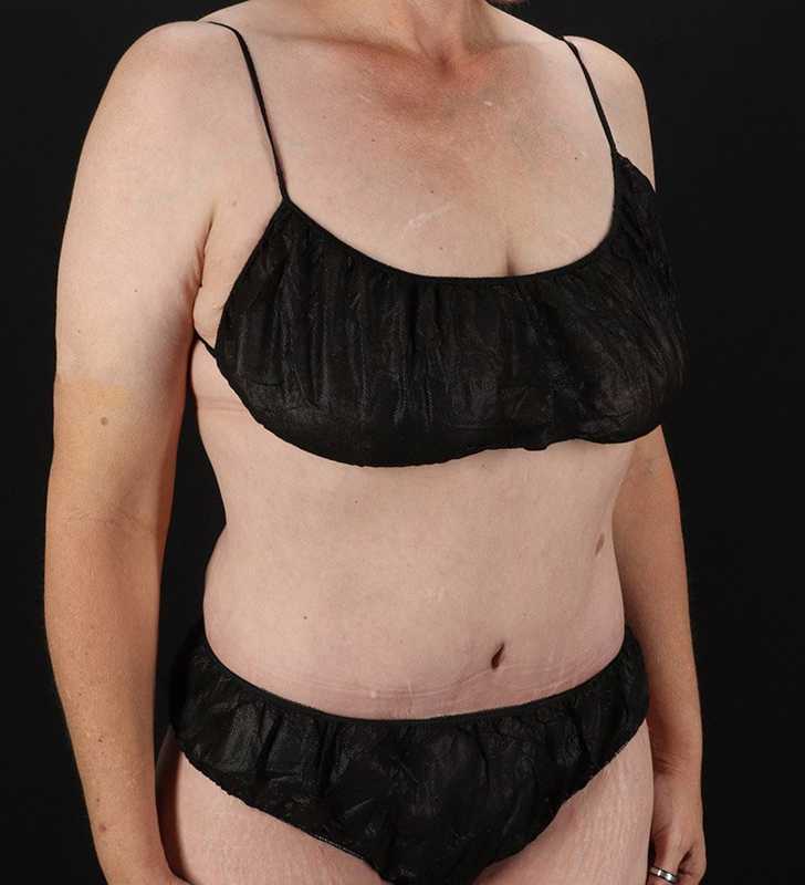 Circumferential Body Lift Before & After Patient #2624