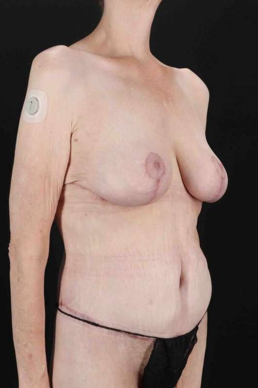Circumferential Body Lift Before & After Patient #2663