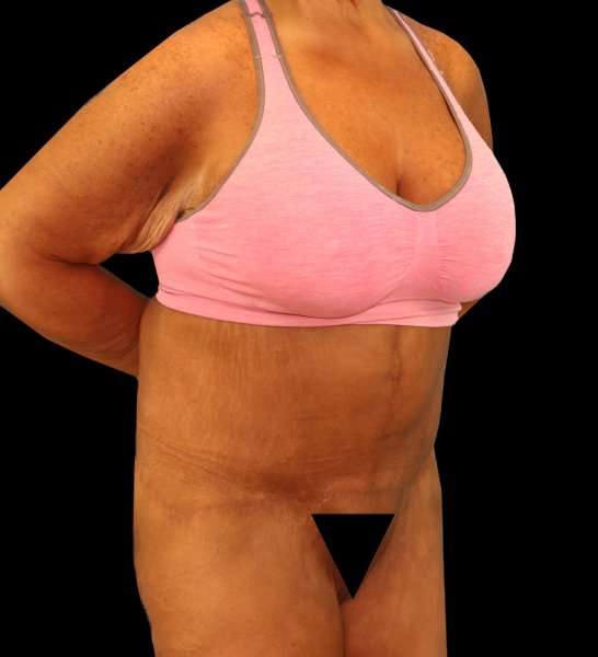 Fleur De Lis Circumferential Body Lift Before & After Patient #2674