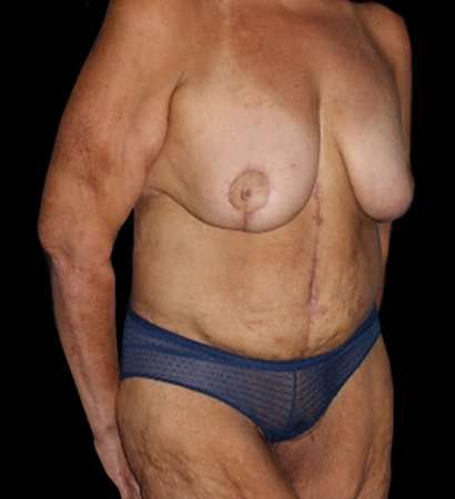Fleur De Lis Circumferential Body Lift Before & After Patient #2685