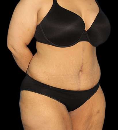 Fleur De Lis Tummy Tuck Before & After Patient #2703