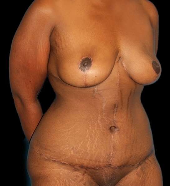 Fleur De Lis Tummy Tuck Before & After Patient #2714