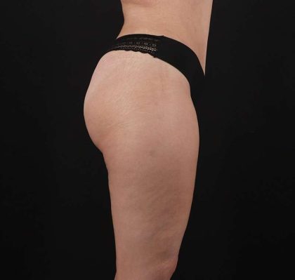 Liposuction Before & After Patient #2736