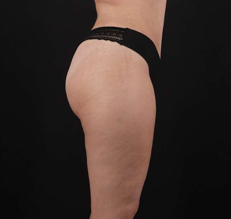 Liposuction Before & After Patient #2736