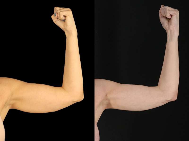 Liposuction Before & After Patient #2743