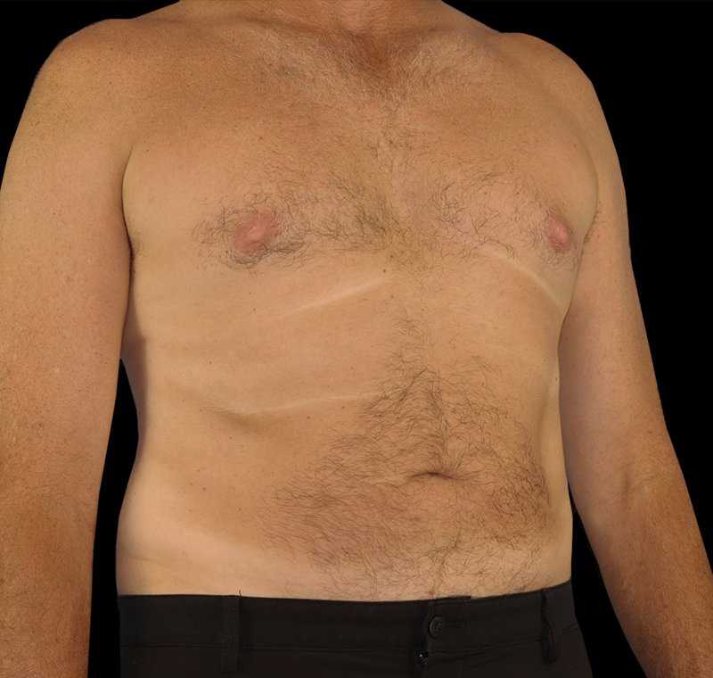 Liposuction Before & After Patient #2756