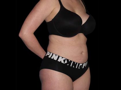 Liposuction Before & After Patient #2778