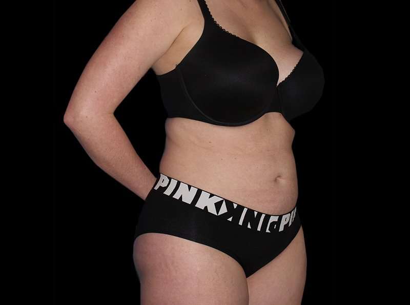 Liposuction Before & After Patient #2778
