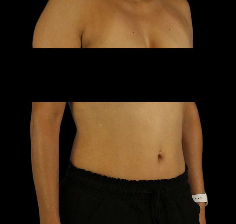 Liposuction Before & After Patient #2811