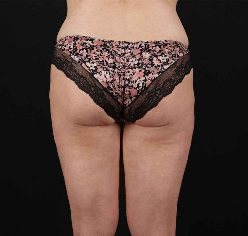Liposuction Before & After Patient #2816