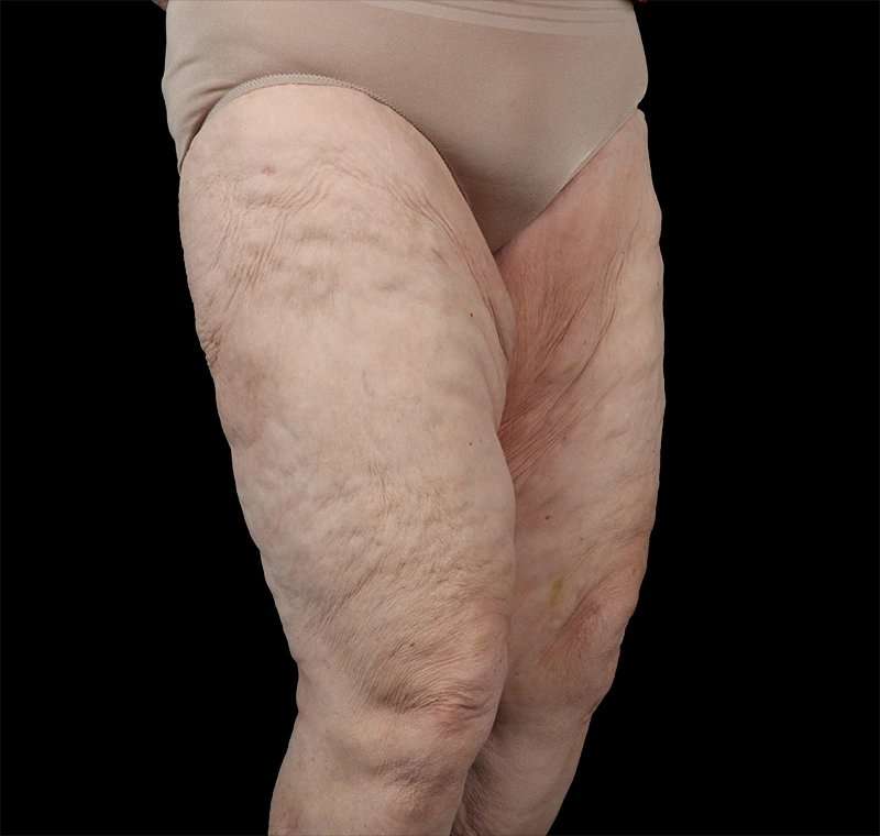 Liposuction Before & After Patient #2829