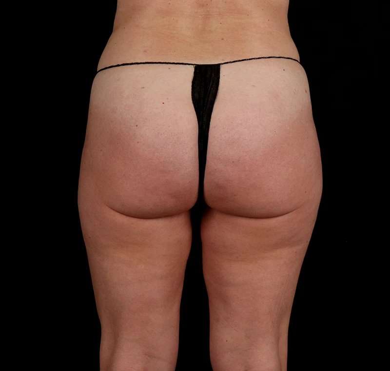 Liposuction Before & After Patient #2834
