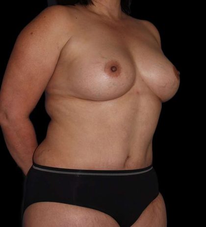 Mommy Makeover Before & After Patient #2878