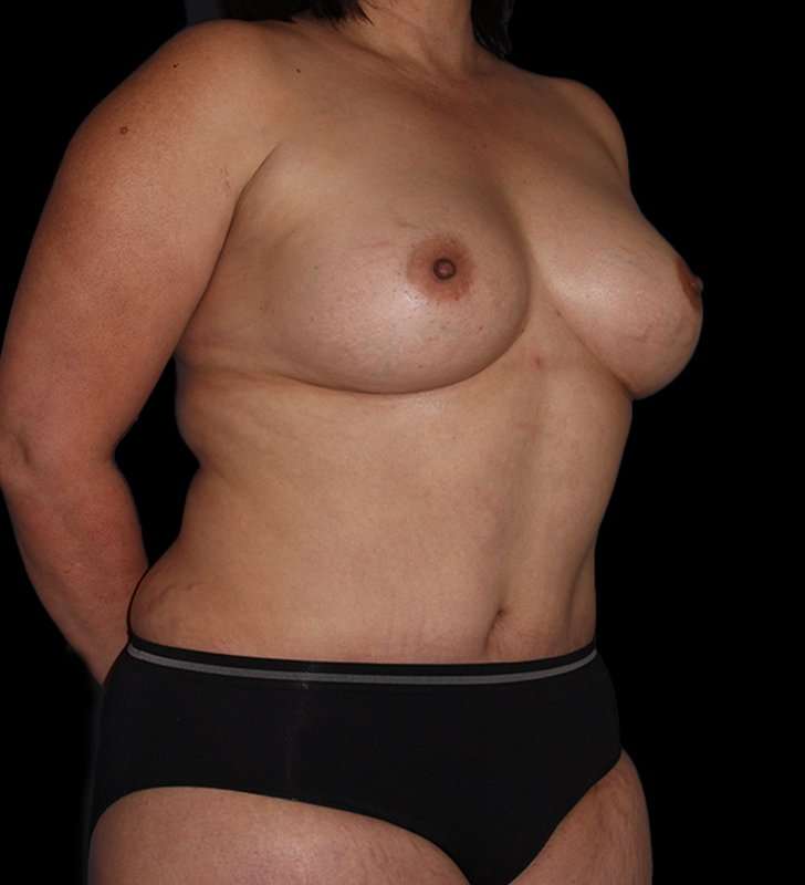 Mommy Makeover Before & After Patient #2878