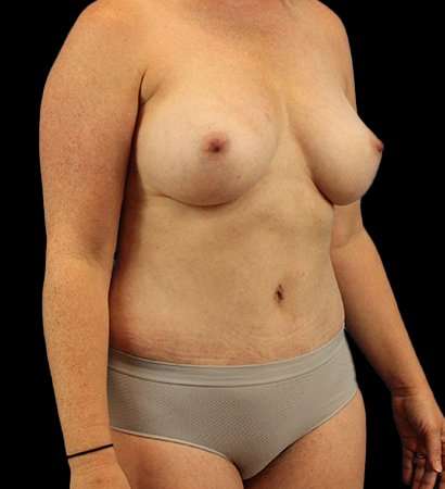 Mommy Makeover Before & After Patient #2974