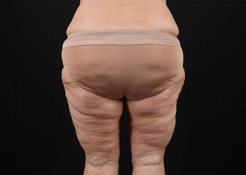 Thigh Lift Before & After Patient #2979