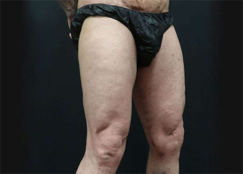 Thigh Lift Before & After Patient #2992
