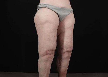 Thigh Lift Before & After Patient #3005
