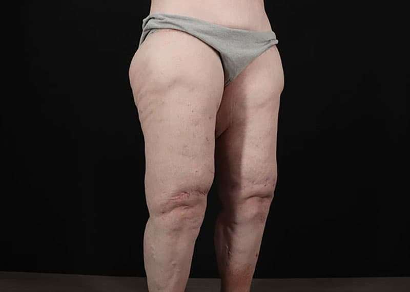 Thigh Lift Before & After Patient #3005