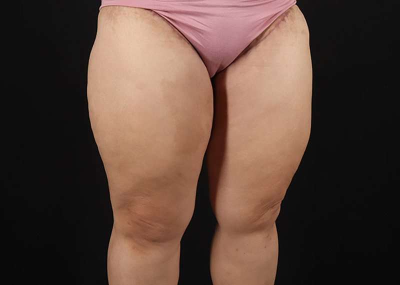 Thigh Lift Before & After Patient #3018