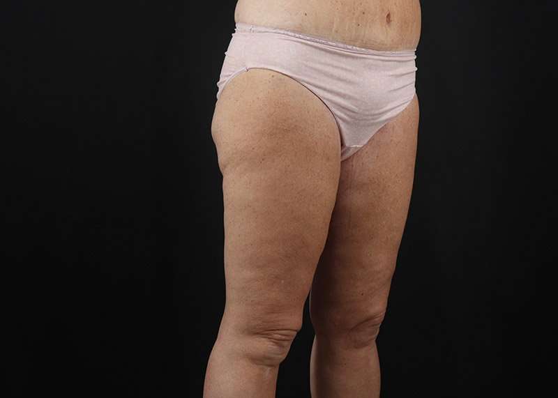 Thigh Lift Before & After Patient #3031