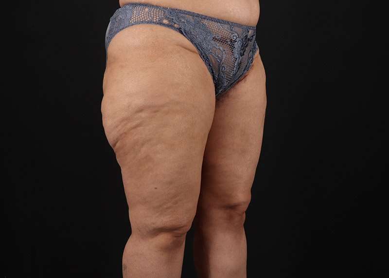 Thigh Lift Before & After Patient #3044