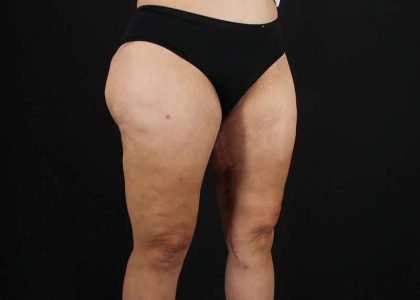 Thigh Lift Before & After Patient #3057