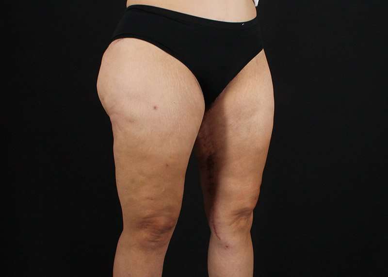 Thigh Lift Before & After Patient #3057