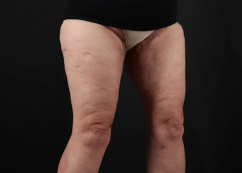 Thigh Lift Before & After Patient #3070