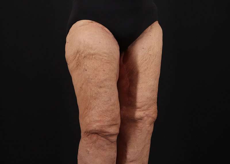 Thigh Lift Before & After Patient #3083
