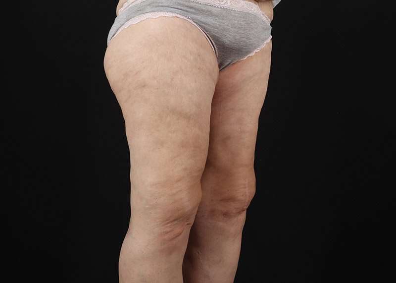 Thigh Lift Before & After Patient #3096