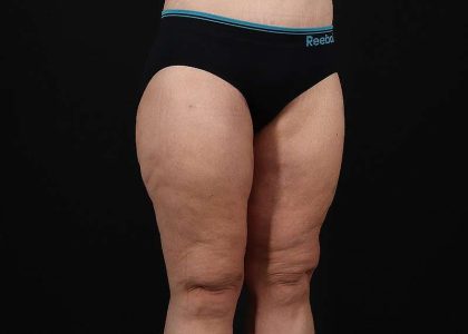 Thigh Lift Before & After Patient #3109